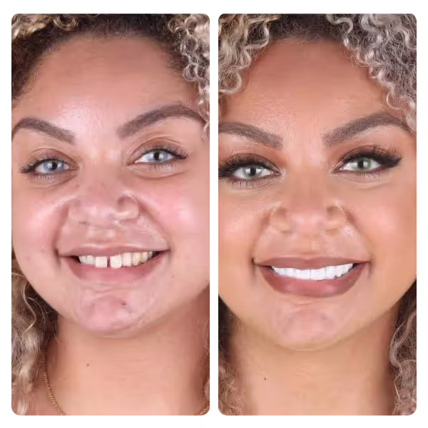 Zirconium Tooth Veneers in Turkey